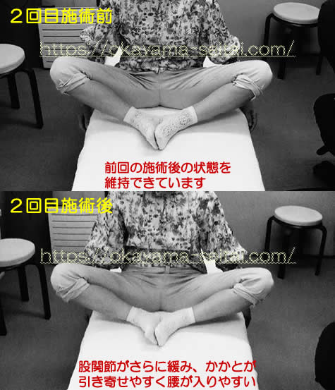 股関節の可動域制限 2回目施術前後の変化の写真