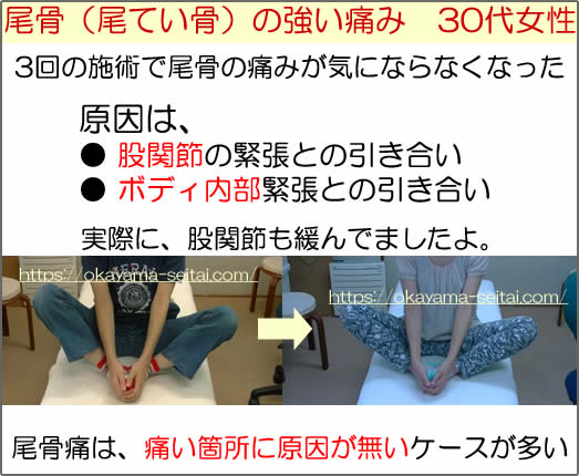 股関節の緊張が尾骨痛に関与。改善後、股関節も緩んだ写真。
