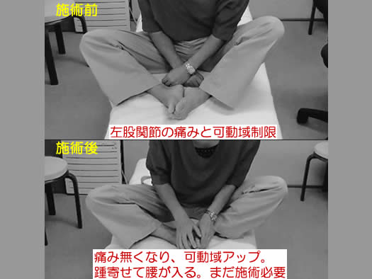 自律神経の乱れが起こす緊張を解放して、その場で、股関節痛と股関節の可動域が変化した事例
