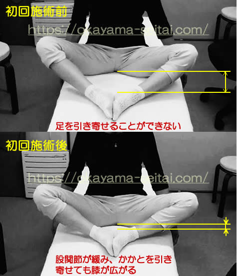 股関節の可動域制限 初回施術前後の変化の写真