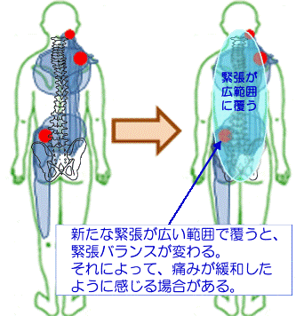 緊張が覆うことで緊張バランスが変わり痛点がぼやけるイメージ図