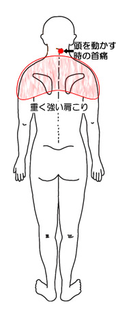 頭を動かすときの首痛と重く強い肩こりの図