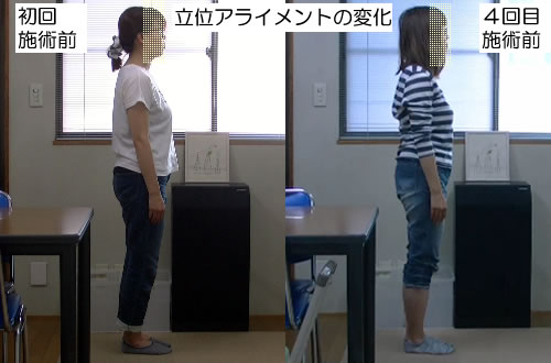 初回施術前と4回目施術前の立位スナップショット