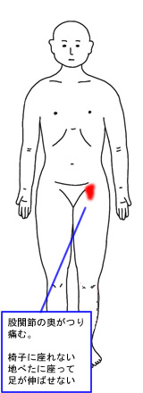 股関節がつり痛く、椅子に1分しか座れない。ベッドで足が伸ばせない。